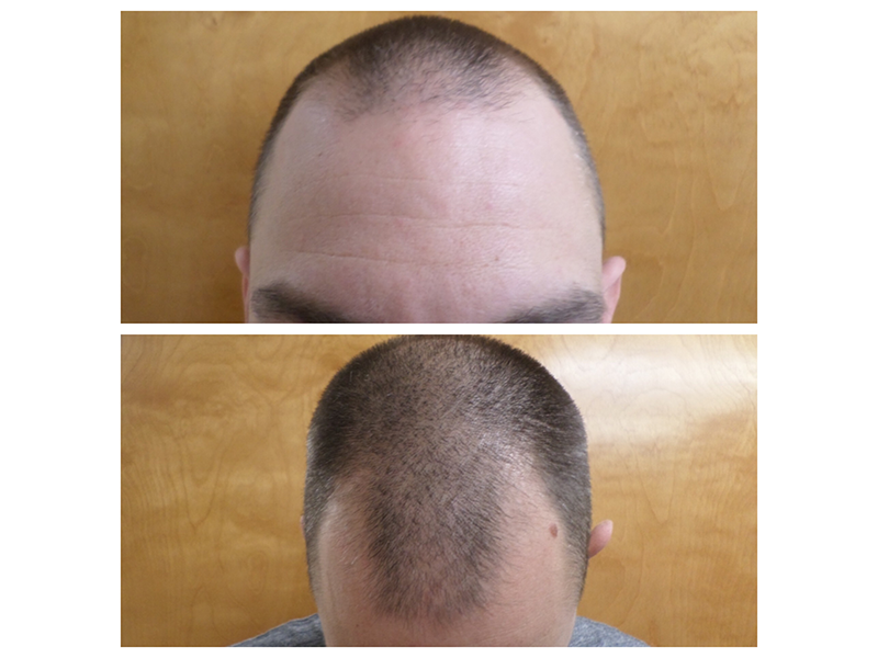 Reversing Male Pattern Baldness with Hair Transplants in New York post thumbnail image