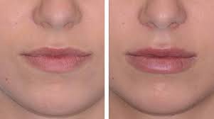 Finding the Right Surgeon for Lip Fillers Santa Barbara Treatment post thumbnail image