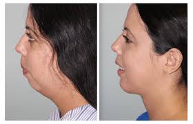 Chin Enhancement 101: The Art of Filler Injections post thumbnail image